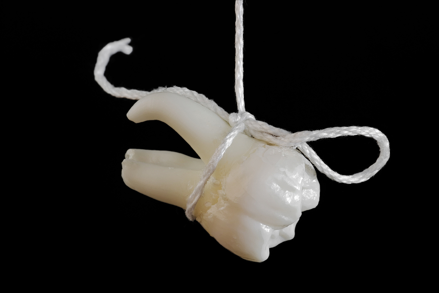 Understanding Dental Extractions: When and Why They’re Necessary