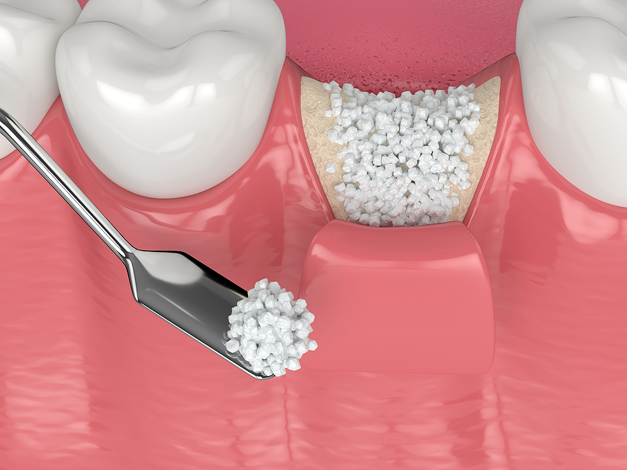 Strengthening Smiles: Understanding Bone Grafts in Oakland, CA