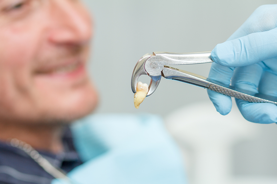 Dental Extractions Explained: Procedures, Benefits, and Recovery