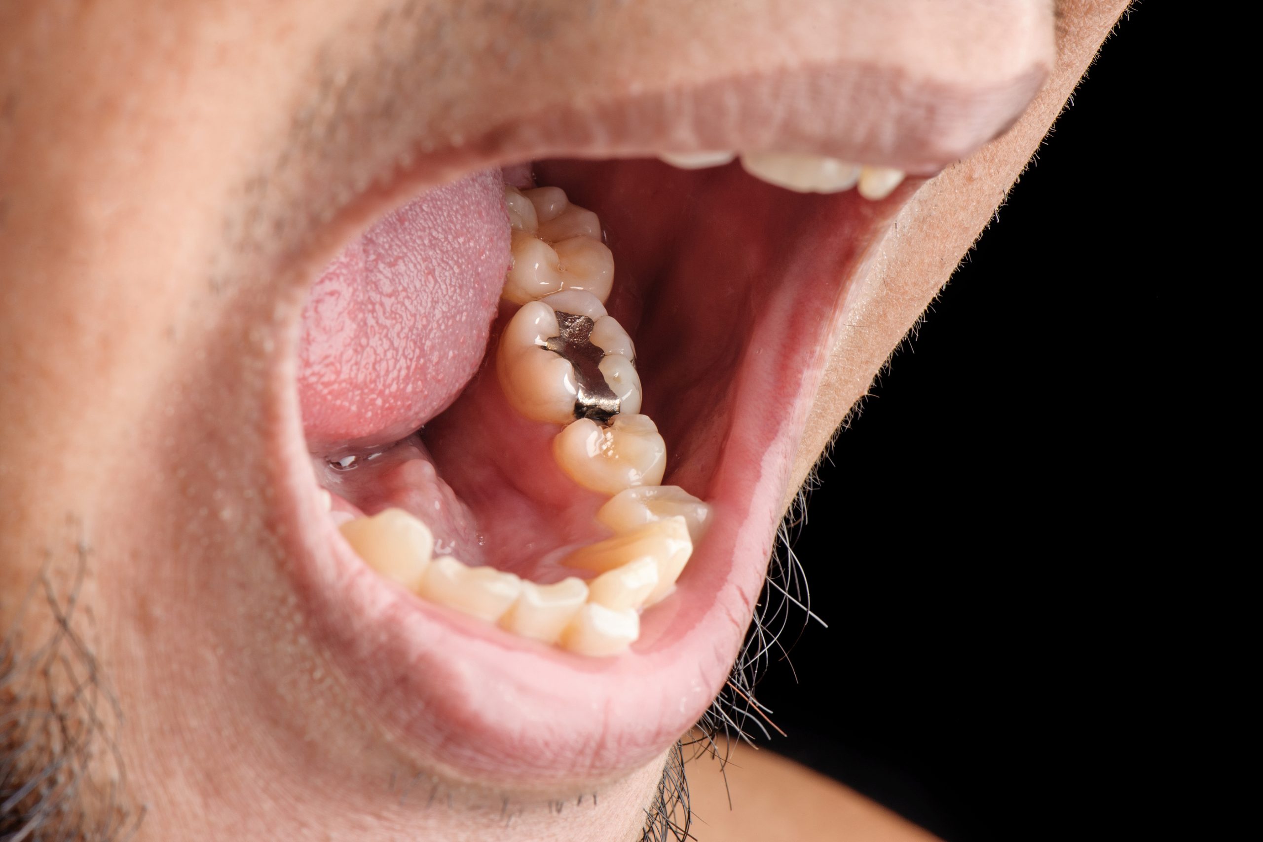 Restoring Your Smile with Dental Fillings in Oakland, CA