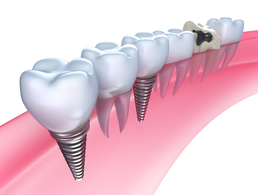 A Complete Guide to Dental Implants in Oakland, CA: Restoring Smiles with Precision and Care